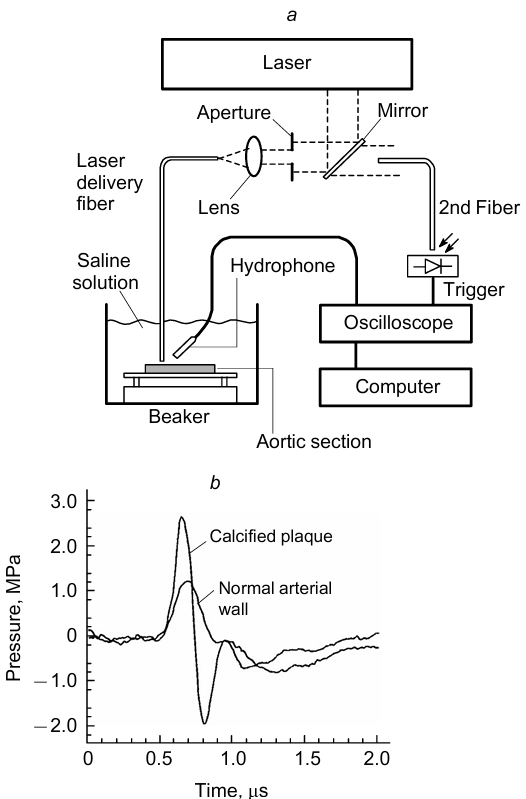 Flow diagram of the facility for detection of ablation products of biological tissues (a) and time dependences of the signal of acoustic waves for the vascular wall in the normal state and in the calcified state (b).167 Published with permission from AIP Publishing.